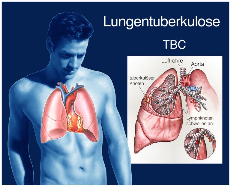 Fallbericht: Manifestation der subklinischen extrapulmonalen Tuberkulose nach COVID-19-Impfung als supraklavikuläre Lymphadenopathie